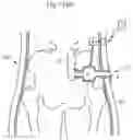 Fig. 96 - APPARATUS FOR CONTROLLING FLOW IN A BODILY ORGAN