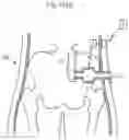 Fig. 97 - APPARATUS FOR CONTROLLING FLOW IN A BODILY ORGAN
