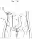 Fig. 98 - APPARATUS FOR CONTROLLING FLOW IN A BODILY ORGAN