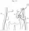 Fig. 99 - APPARATUS FOR CONTROLLING FLOW IN A BODILY ORGAN