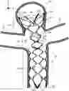 Fig. 01 - Aneurysm implant support device