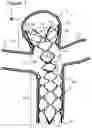 Fig. 02 - Aneurysm implant support device