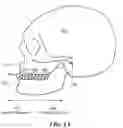 Fig. 02 - Orthodontic distalization and mesialization apparatus and method