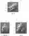 Fig. 05 - DENTAL IMPLANT