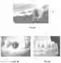 Fig. 06 - DENTAL IMPLANT