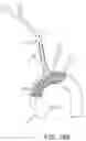 Fig. 20 - Systems and methods for transcatheter aortic valve treatment