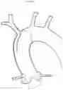 Fig. 09 - ASCENDING AORTIC STENT GRAFT