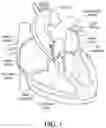 Fig. 02 - ANNULOPLASTY RING ASSEMBLY WITH DETACHABLE HANDLE