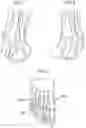 Fig. 02 - COUNTERFORCE BRACE