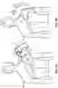 Fig. 03 - BRACE TO COVER ATROPHY IN THE SHOULDER