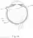 Fig. 06 - Guide apparatus for tangential entry into suprachoroidal space