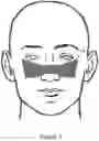 Fig. 09 - NASAL COMPRESSION DEVICE