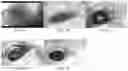 Fig. 02 - Composition of corneal implantation, and the use and preparation method thereof