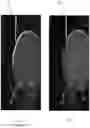 Fig. 07 - COMPOSITE IMPLANT MATERIAL