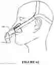 Fig. 40 - NASAL SEAL AND RESPIRATORY INTERFACE