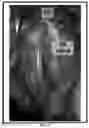 Fig. 07 - PERCUTANEOUS PULMONARY ARTERY DRAINAGE DEVICE