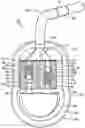 Fig. 01 - Implantable intracranial pulse pressure modulator and system and method for use of same