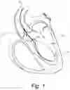 Fig. 02 - Heart support device with directional flow assist