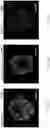 Fig. 52 - CELL POPULATIONS AND GENE EXPRESSION ASSOCIATED WITH IN VITRO BETA CELL DIFFERENTIATION