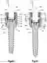 Fig. 09 - Revision connector for spinal constructs
