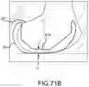 Fig. 197 - Systems and methods for surgical planning of arthroplasty procedures