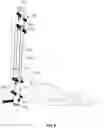 Fig. 07 - Arthrodesis devices for generating and applying compression within joints