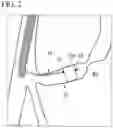 Fig. 03 - METHOD FOR COLLECTING TISSUE IN BILE DUCT