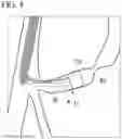 Fig. 05 - METHOD FOR COLLECTING TISSUE IN BILE DUCT