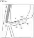 Fig. 07 - METHOD FOR COLLECTING TISSUE IN BILE DUCT