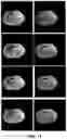 Fig. 10 - Methods of image reconstruction to reduce artifacts in rapid CBCT scans