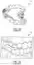 Fig. 02 - Clear plastic aligner protrusions for anterior or open bite treatment and mattress plastic material for invisible aligners