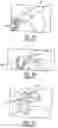 Fig. 04 - Clear plastic aligner protrusions for anterior or open bite treatment and mattress plastic material for invisible aligners
