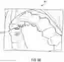 Fig. 11 - Clear plastic aligner protrusions for anterior or open bite treatment and mattress plastic material for invisible aligners