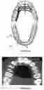 Fig. 16 - ASSEMBLY FOR DENTAL RESTORATION
