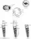 Fig. 06 - Dental implant