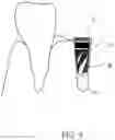 Fig. 09 - One single drill dental implant system and Method for Use Thereof