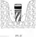 Fig. 10 - One single drill dental implant system and Method for Use Thereof