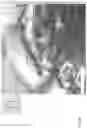 Fig. 03 - SNAPPING OF DENTURE TEETH