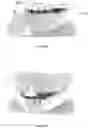 Fig. 19 - Oral applicator device