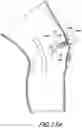 Fig. 23 - TISSUE CAPTURING BONE ANCHOR