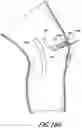 Fig. 28 - TISSUE CAPTURING BONE ANCHOR
