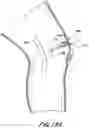 Fig. 33 - TISSUE CAPTURING BONE ANCHOR