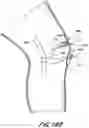 Fig. 34 - TISSUE CAPTURING BONE ANCHOR