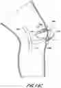 Fig. 35 - TISSUE CAPTURING BONE ANCHOR
