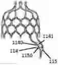 Fig. 01 - Heart valve prosthesis anchored to interventricular septum and conveying and releasing method thereof