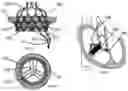 Fig. 02 - Heart valve prosthesis anchored to interventricular septum and conveying and releasing method thereof