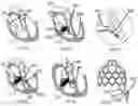 Fig. 04 - Heart valve prosthesis anchored to interventricular septum and conveying and releasing method thereof