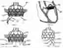 Fig. 05 - Heart valve prosthesis anchored to interventricular septum and conveying and releasing method thereof
