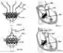 Fig. 09 - Heart valve prosthesis anchored to interventricular septum and conveying and releasing method thereof