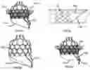 Fig. 10 - Heart valve prosthesis anchored to interventricular septum and conveying and releasing method thereof